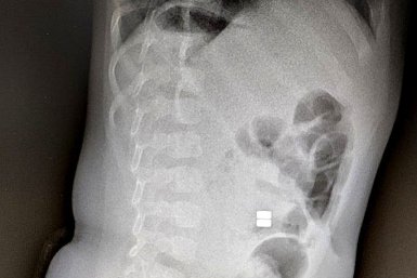 Проглоченные магнитные шарики - серьезная проблема, которая требует немедленного хирургического вмешательства министерство здравоохранения Амурской области