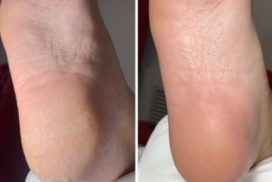 Трещинки на пятках разгладились на глазах: шершавая кожа теперь мягче бархата — делюсь секретом