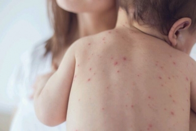 Как распознать корь на ранней стадии