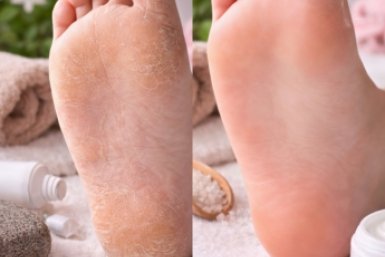 Вместо пемзы беру 1 продукт из холодильника — через 30 минут пятки нежнее шелка, натоптыши отваливаются сами