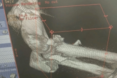 Медики Ставрополя спасли мужчину, упавшего с 6-метровой высоты