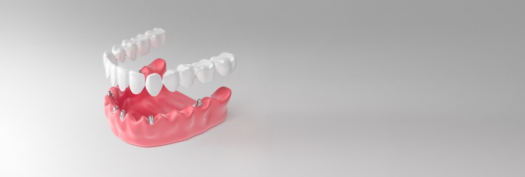 Скуловые имплантаты