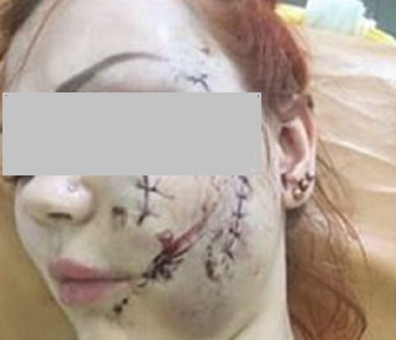 Девушку, которой на Кубани в караоке изуродовали лицо стаканом, признали потерпевшей