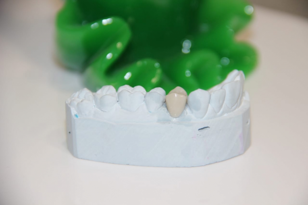 Зубные протезы нового поколения для уссурийцев ctom_yspex