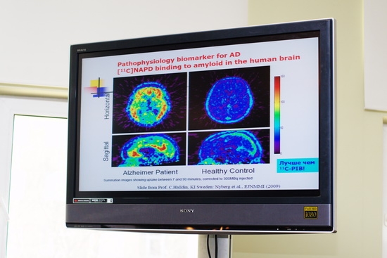 Снимок, полученный с помощью ПЭТ-КТ, при исследовании болезни Альцгеймера Анна Степанкина