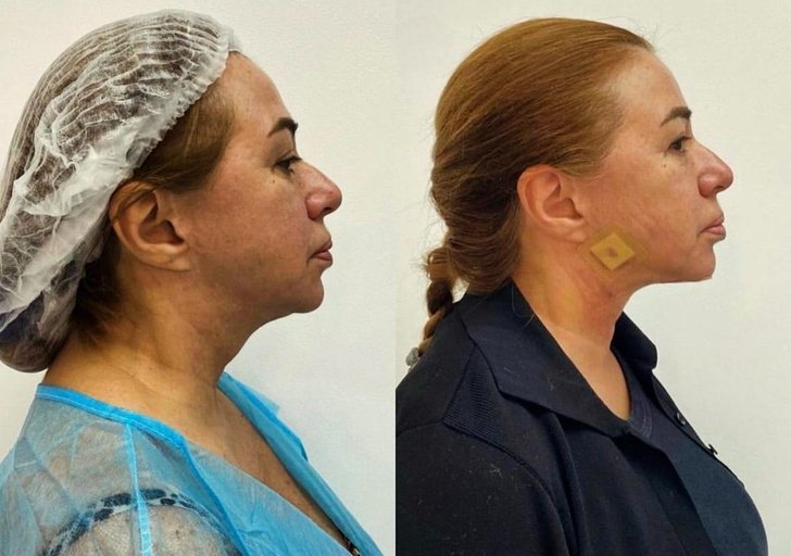 Алена Апина до и после операции