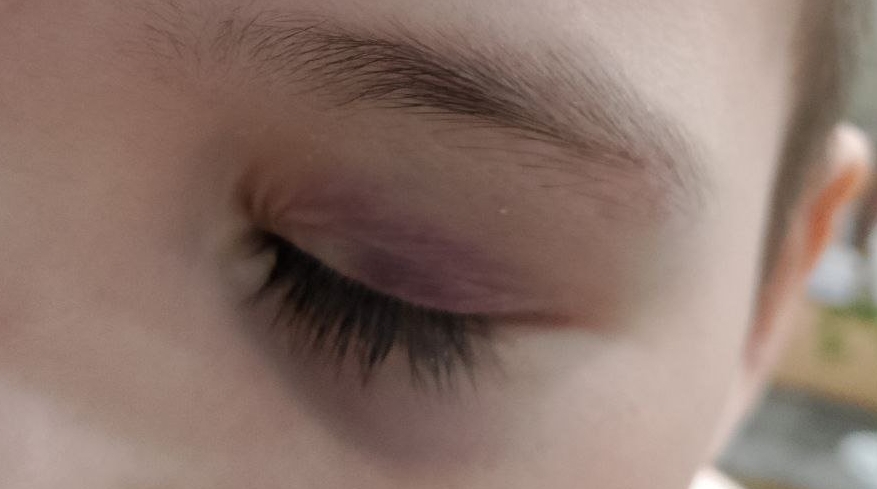 Синяк на веке у ребёнка предоставлено мамой мальчика