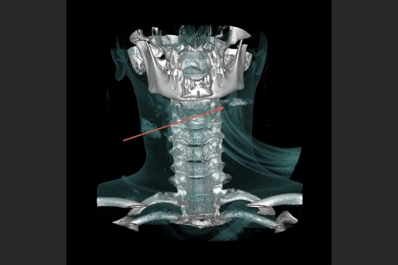 На снимке показано расположение пули предоставлено Краевой клинической больницей №2