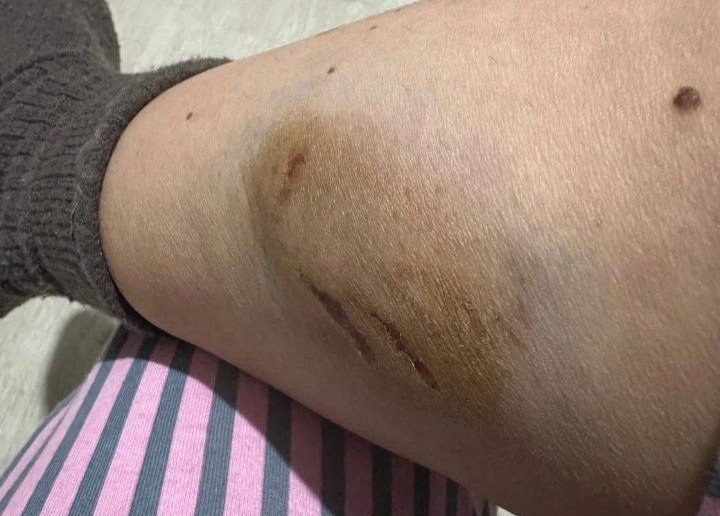 Собака оставила страшную рану пострадавшей Фотография пострадавшей женщины