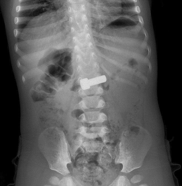 Годовалый малыш проглотил болт в Подмосковье Telegram / &quotРазборчивым почерком&quot