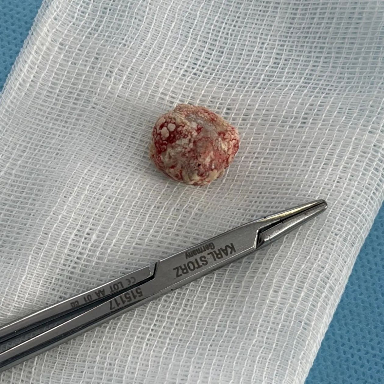 Камень из слюнной железы удалили жителю Приморья Tg-канал (18+) Краевой клинической больницы № 2