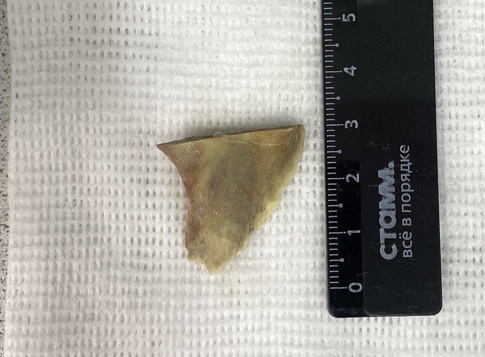 Врачи извлекли острый фрагмент кости, угрожавший перфорацией пищевода БСМП