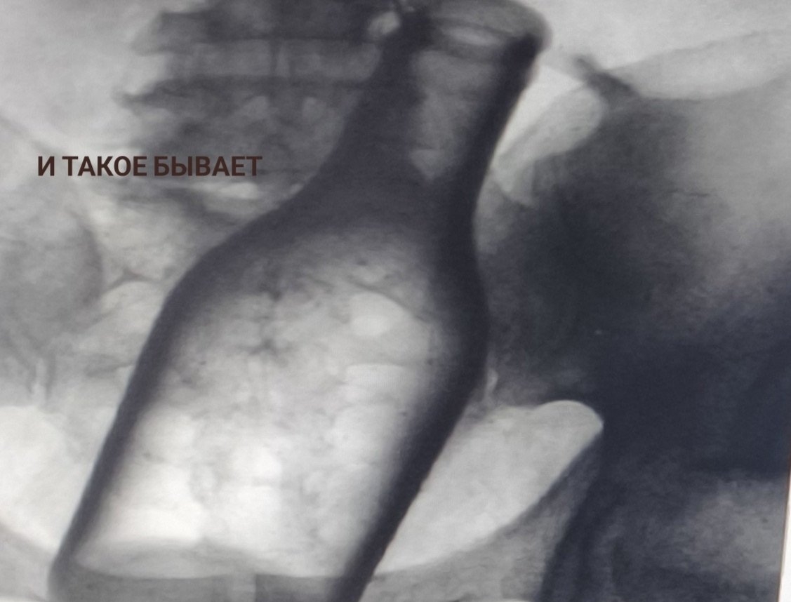 От коронки до бутылки: рейтинг находок внутри пациентов составила больница Пятигорска телеграм-канал (18+) ГКБ Пятигорска
