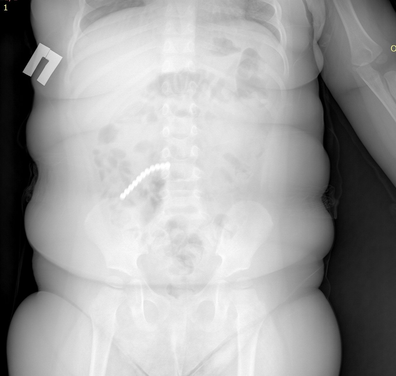 Малыш в Бурятии проглотил 20 магнитных шариков ДРКБ Бурятии