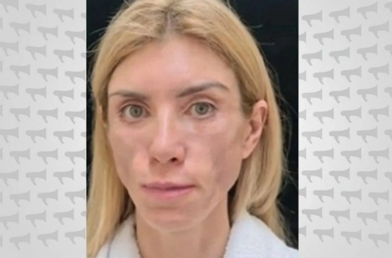 В Краснодаре модель отсудила у клиники более 8 млн рублей за изуродованное лицо Скриншот видео ren.tv