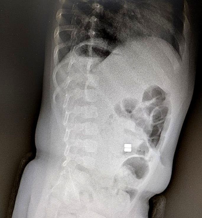Проглоченные магнитные шарики - серьезная проблема, которая требует немедленного хирургического вмешательства министерство здравоохранения Амурской области