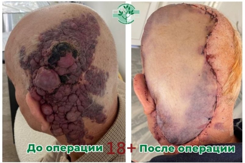 Огромную опухоль удалили с кожи головы пациенты нейрохирурги в Ставрополе Минздрав Ставрополья (18+)