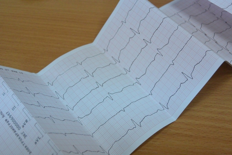 Электрокардиографическое исследование (ЭКГ) Наталья Баграновская, ИА EAOmedia