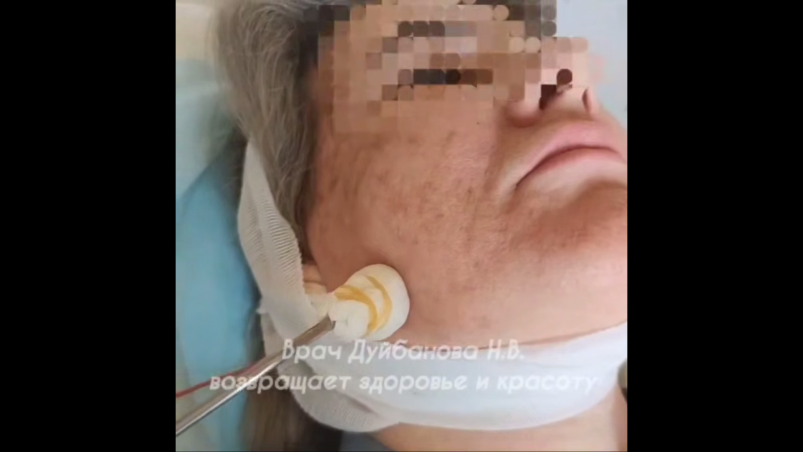 Улан-удэнка получила ожог лица у косметолога и повреждение нерва скриншот видео