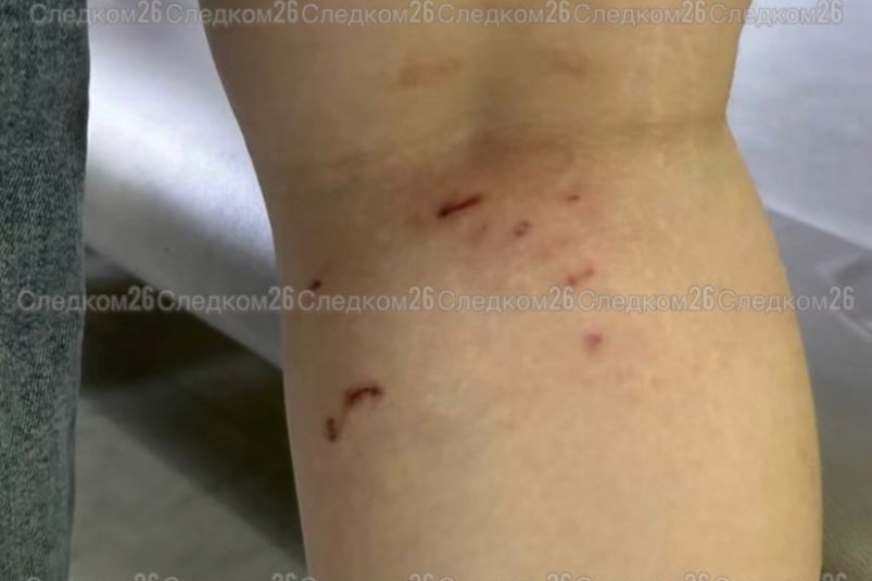 Уголовное дело после нападения собак на девочку возбудили в Минводах пресс-служба СУ СКР по Ставрополью