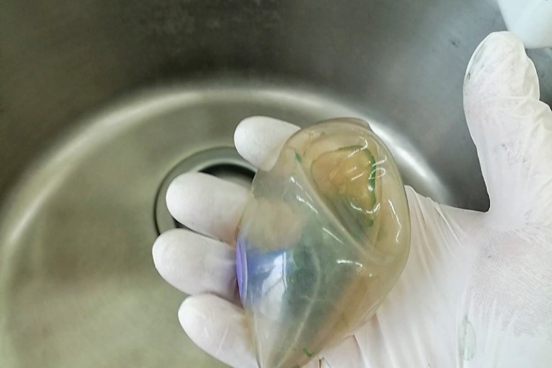 Желание не толстеть чуть не стоило жизни женщине в Находке Находкинская городская больница Желание не толстеть чуть не стоило жизни женщине в Находке Находкинская городская больница