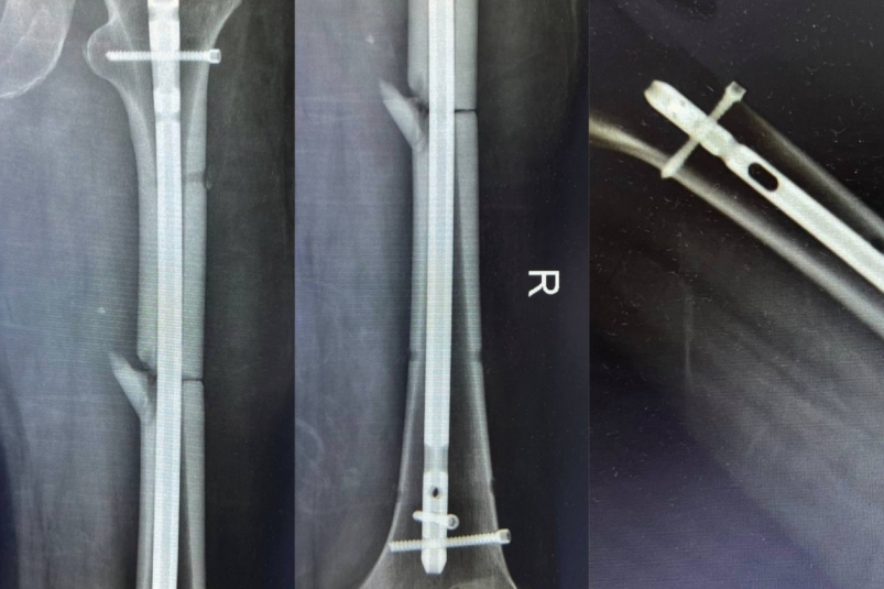 Мужчину, упавшего с 7-метровой высоты, спасли врачи в Ставрополе Минздрав Ставрополья