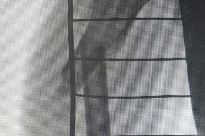 Ребенок сломал бедро, катаясь на ватрушке ДРКБ Бурятии