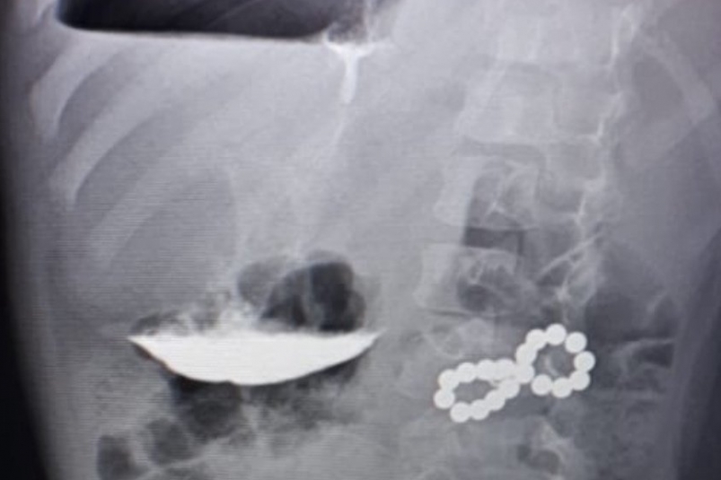 Малыша, проглотившего 18 магнитов, спасли медики в Ставрополе пресс-служба Ставропольской краевой клинической больницы