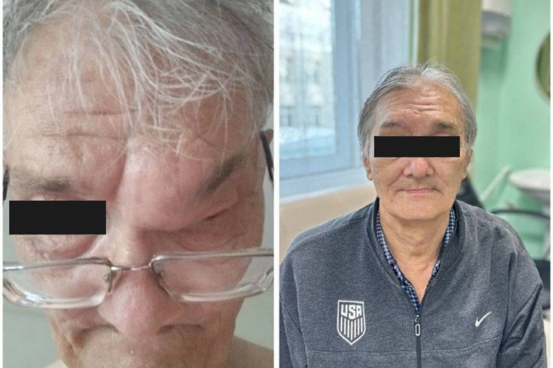 В Бурятии мужчине опухоль разрушила череп РКБ им. Семашко