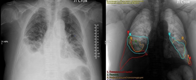ИИ стал помощником рентгенологов в Бурятии РКБ им. Семашко