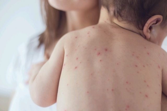 Корь Мэрия Якутска